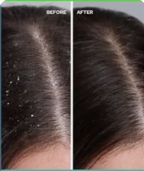 Anti Dandruff Treatment | Clean Scalp Patna at Kritika Ladies Parlour Patna