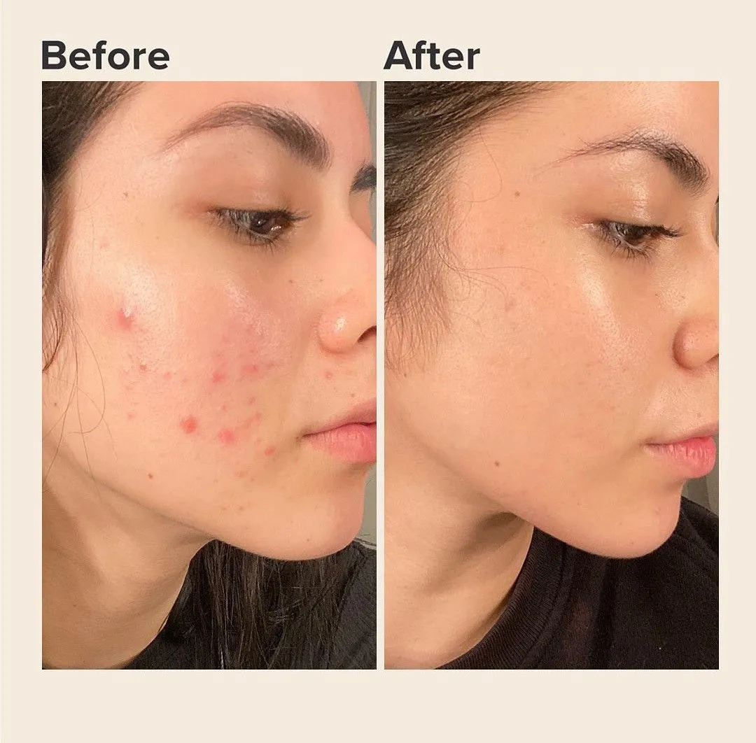 Deep Skin Cleanup | Advanced Pore Detox  at Kritika Ladies Parlour Patna